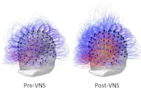 迷走神経刺激の前と後（Pre-VNSとPost-VNS）に、植物状態の患者の脳内でどのように情報の共有が増加したかを表すイラストレーション。（PHOTOGRAPH BY CORAZZOL ET AL）