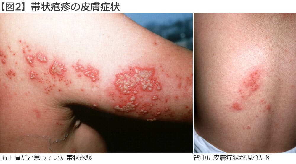 多忙で休めないあなた 他人事ではない 帯状疱疹 Nikkei Style 多忙で休めないあなた 他人事ではない 帯状疱疹 Nikkei Style