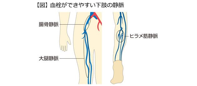 長時間同じ姿勢でいると血液がうっ滞 ロングフライト症候群 の予防策 間違いは Nikkei Style 長時間同じ姿勢でいると血液がうっ滞 ロングフライト症候群 の予防策 間違いは Nikkei Style