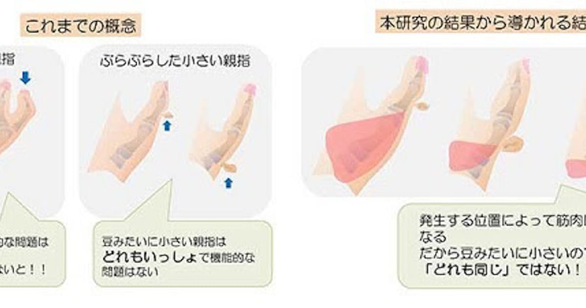京大 親指多指症における筋肉の発達は親指が生じる位置で規則的に決まることを発見 日本経済新聞
