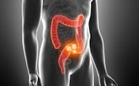 飲酒、喫煙、肥満、運動不足、感染症…。どれが確実に大腸がんのリスクを高めるでしょう。画像はイメージ=(c)Sebastian Kaulitzki-123RF