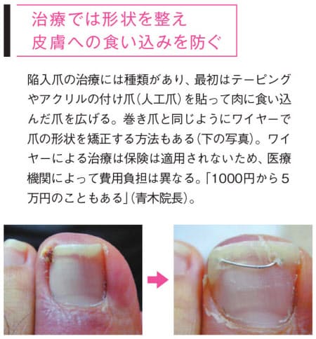 巻き爪 食い込んだ爪 カールしないよう爪を広げる Nikkei Style 巻き爪 食い込んだ爪 カールしないよう爪を広げる Nikkei Style