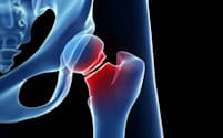 2017年、お酒で顔が赤くなる人は大腿骨骨折を起こしやすい、というニュースが流れた。これは本当だろうか。そしてその影響は？ (c)Sebastian Kaulitzki-123RF