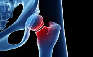 2017年、お酒で顔が赤くなる人は大腿骨骨折を起こしやすい、というニュースが流れた。これは本当だろうか。そしてその影響は？ (c)Sebastian Kaulitzki-123RF