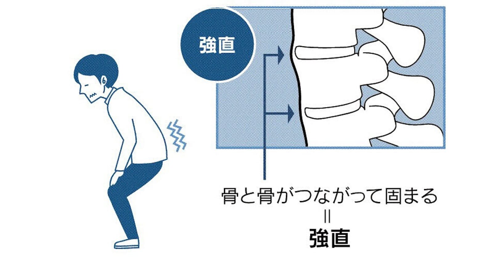 骨が固まる難病 強直性脊椎炎 新薬に期待 Nikkei Style 骨が固まる難病 強直性脊椎炎 新薬に期待 Nikkei Style