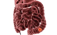 健康診断でもおなじみの便潜血検査ですが、これだけでは見つからない大腸がんもあるようです。写真はイメージ=(c)Kateryna Kon-123RF