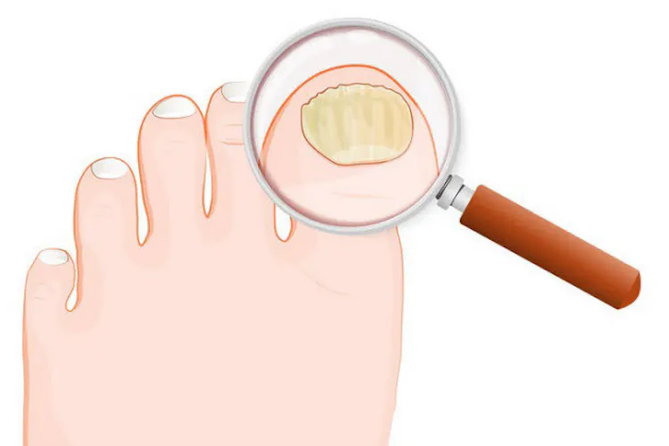 やっかいな爪水虫 治ったと思っても油断は禁物 Nikkei Style やっかいな爪水虫 治ったと思っても油断は禁物 Nikkei Style