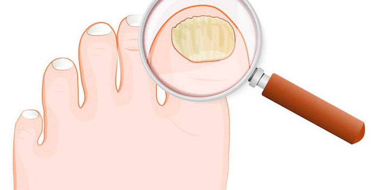 やっかいな爪水虫 治ったと思っても油断は禁物 Nikkei Style やっかいな爪水虫 治ったと思っても油断は禁物 Nikkei Style
