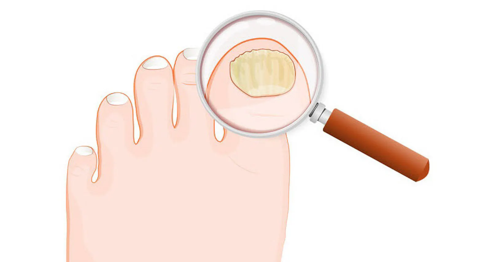 やっかいな爪水虫 治ったと思っても油断は禁物 Nikkei Style やっかいな爪水虫 治ったと思っても油断は禁物 Nikkei Style