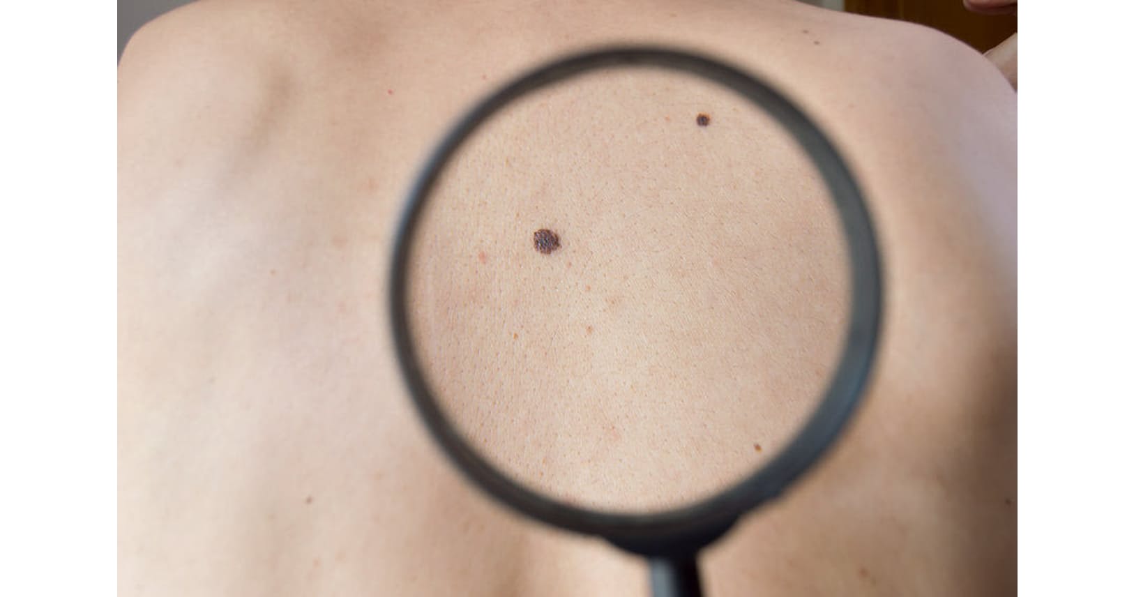 あの場所のホクロが大きくなってきた これ皮膚がん Nikkei Style あの場所のホクロが大きくなってきた これ皮膚がん Nikkei Style