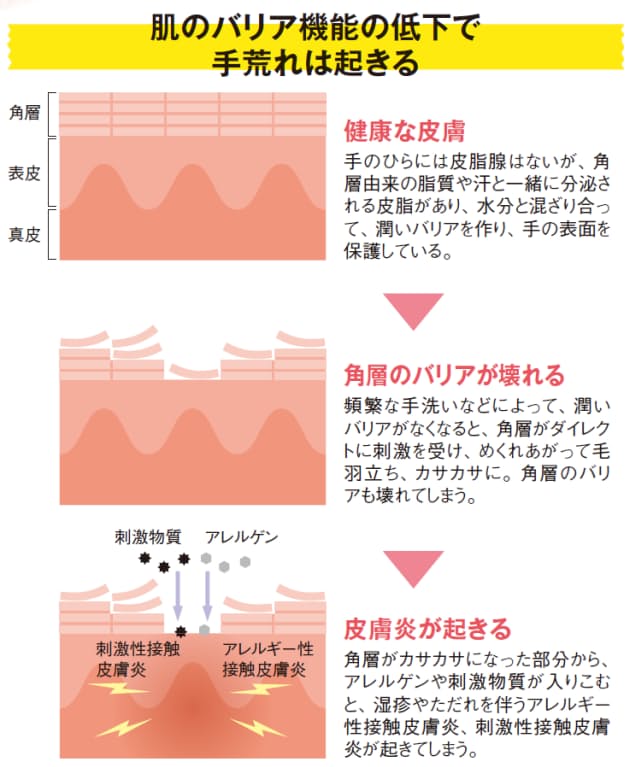 かさつき ひび割れ かゆみ 冬に手が荒れる理由 Nikkei Style かさつき ひび割れ かゆみ 冬に手が荒れる理由 Nikkei Style