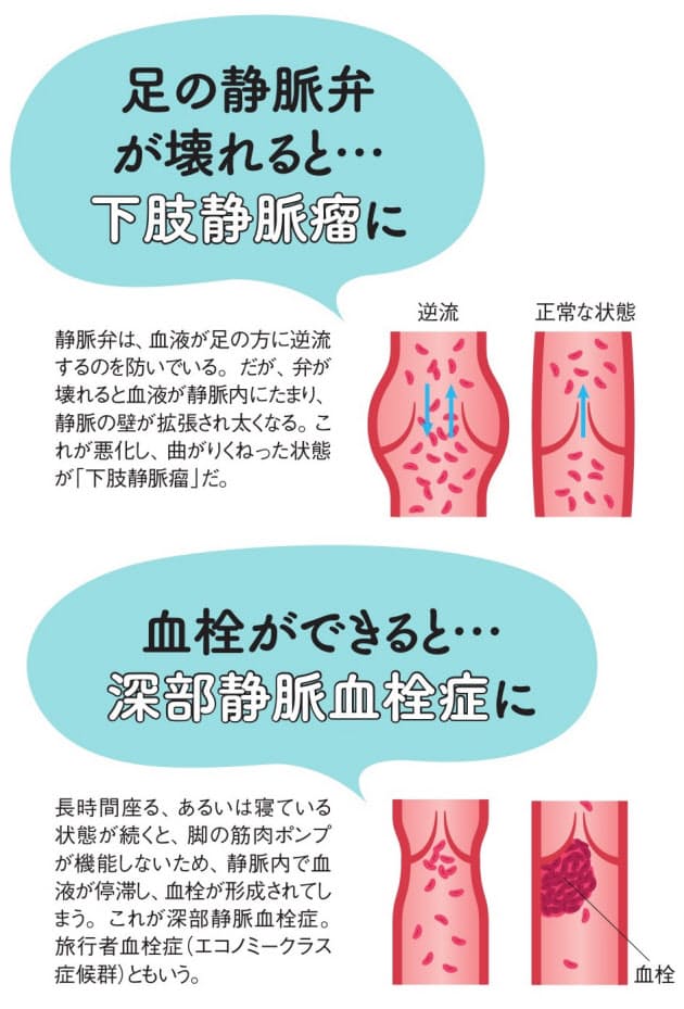 ふくらはぎを使って歩こう 実は多い脚の静脈の病防ぐ Nikkei Style ふくらはぎを使って歩こう 実は多い脚の静脈の病防ぐ Nikkei Style
