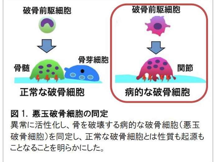 阪大 関節炎で骨を破壊する 悪玉破骨細胞 を発見 日本経済新聞