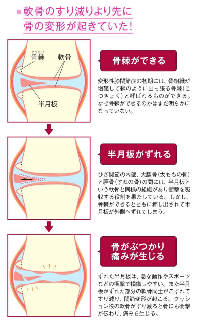 膝の痛みは関節変形のサイン 4つの兆候あれば受診 Nikkei Style
