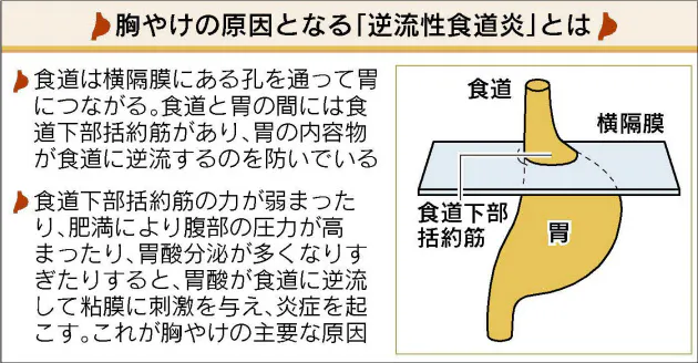 座る姿勢も原因に 胸やけを改善する生活法 Nikkei Style 座る姿勢も原因に 胸やけを改善する生活法 Nikkei Style