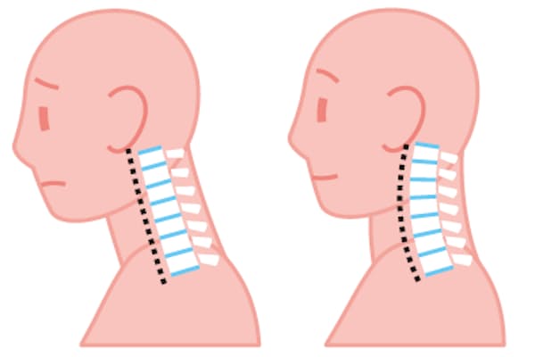 星野監督がかかった 靱帯骨化症 若手も発症 Nikkei Style 星野監督がかかった 靱帯骨化症 若手も発症 Nikkei Style