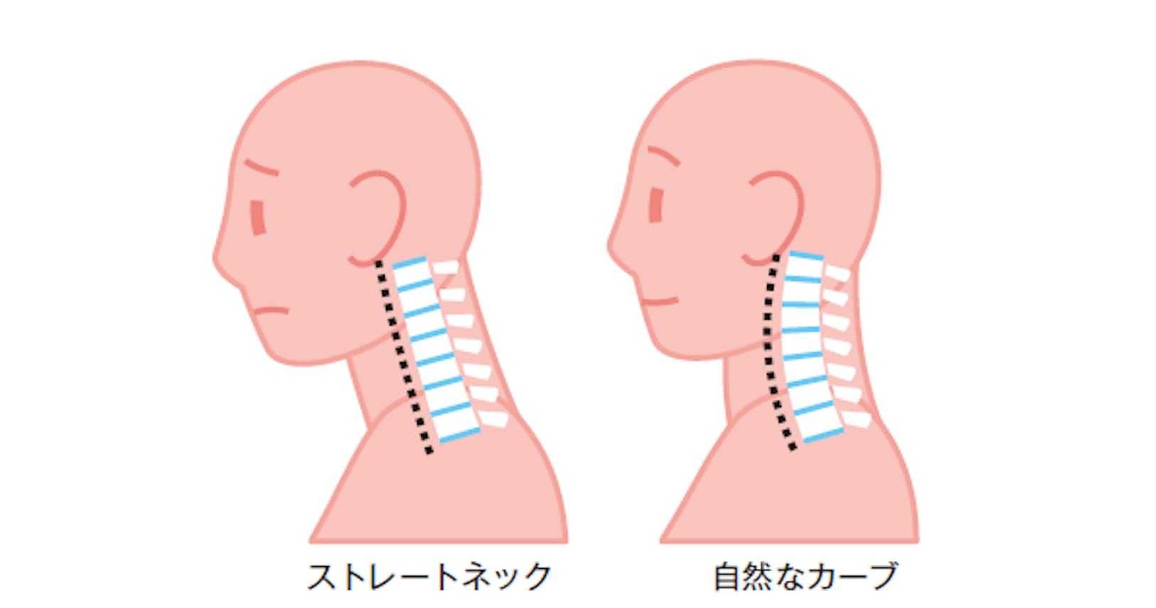 腕のしびれは危険信号 危ない 首こり 対策 Nikkei Style 腕のしびれは危険信号 危ない 首こり 対策 Nikkei Style