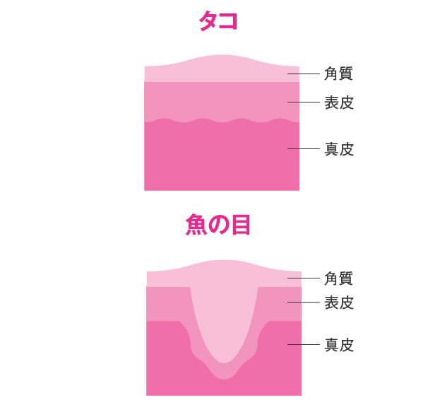 痛み かゆみの元凶 魚の目 タコ イボ 水虫を撃退 Nikkei Style 痛み かゆみの元凶 魚の目 タコ イボ 水虫を撃退 Nikkei Style