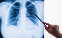 「肺炎」がどんな病気か理解している人は意外と少ない。写真はイメージ(c) WERAYUTH PIRIYAPORNPRAPA-123RF
