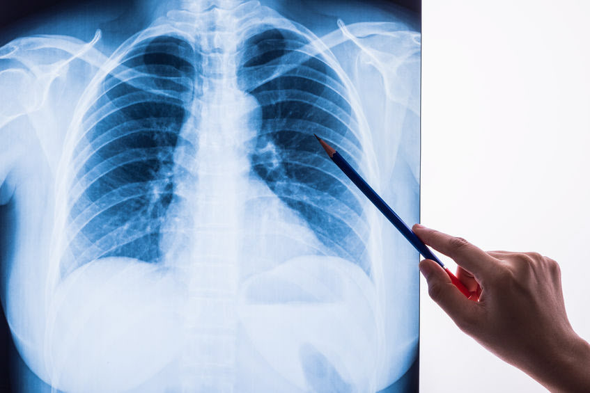 「肺炎」がどんな病気か理解している人は意外と少ない。写真はイメージ(c) WERAYUTH PIRIYAPORNPRAPA-123RF
