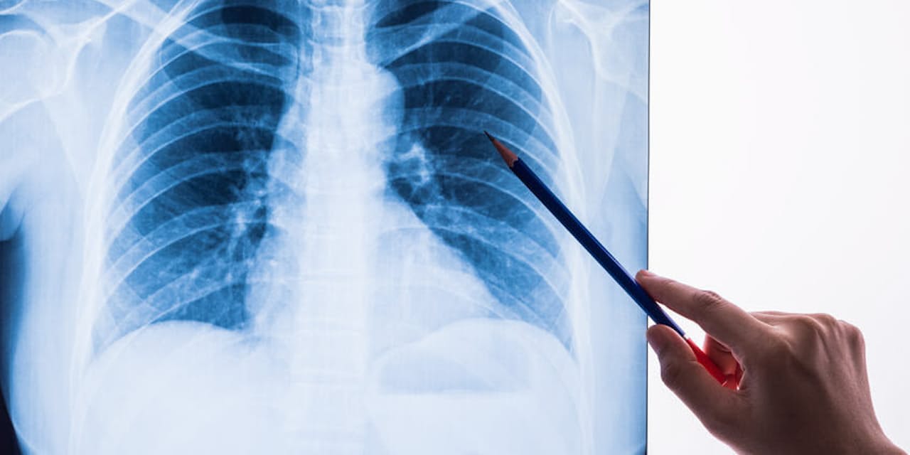 新型コロナによる肺炎 通常の肺炎と何が違うのか Nikkei Style 新型コロナによる肺炎 通常の肺炎と何が違うのか Nikkei Style