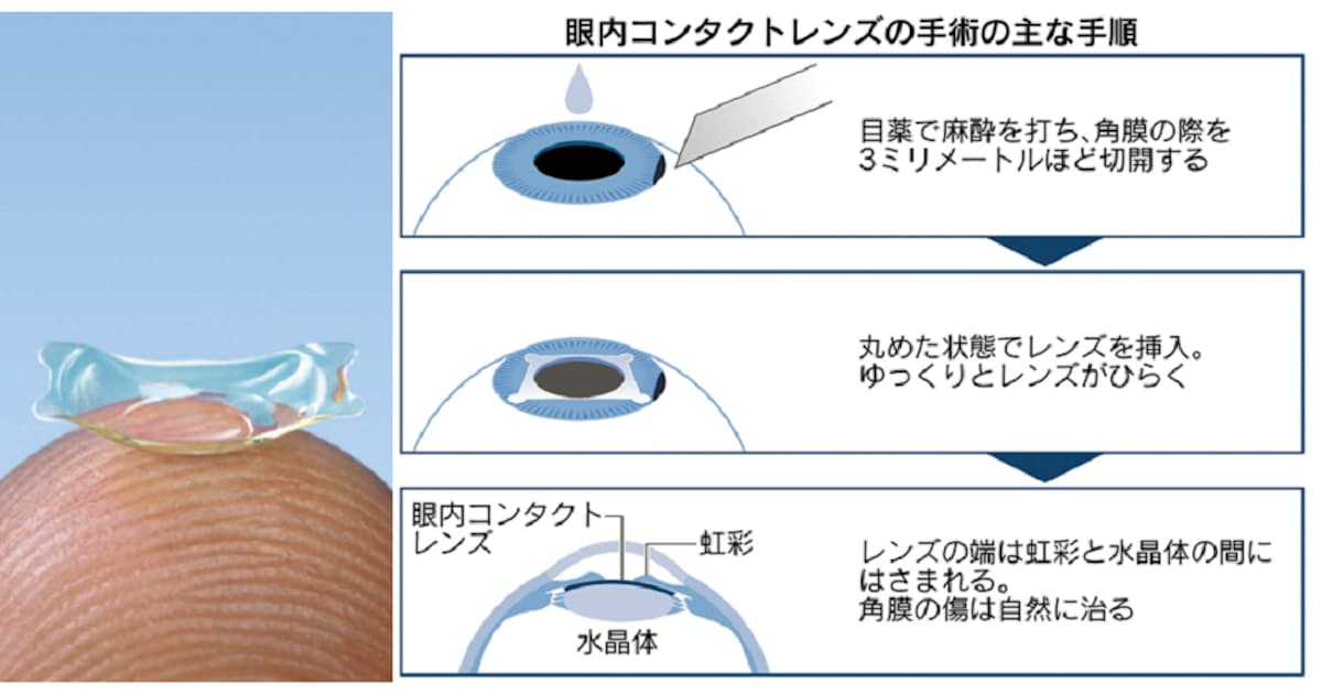 眼内コンタクトレンズで近視矯正 若い世代に浸透 日本経済新聞