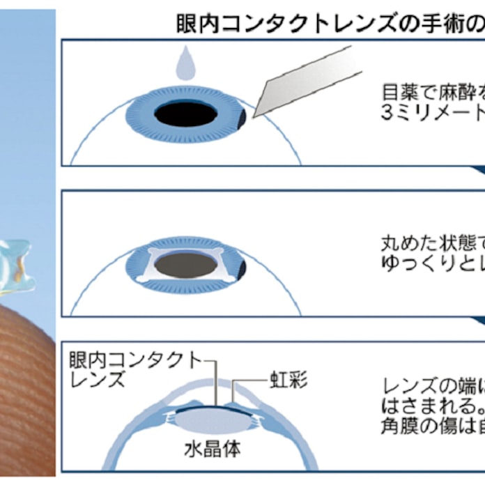 長岡 眼科 近視 近視矯正手術 眼内コンタクトレンズ Icl について 長岡眼科医院