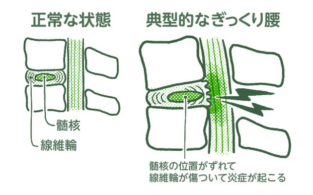 デスクワークでたまる 腰痛借金 3秒体操で解消 Nikkei Style