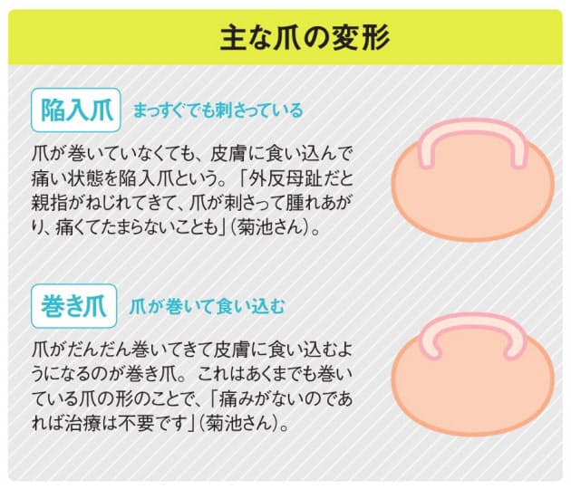 足の巻き爪は歩いて防ぐ 親指で地面を踏みしめよう Nikkei Style