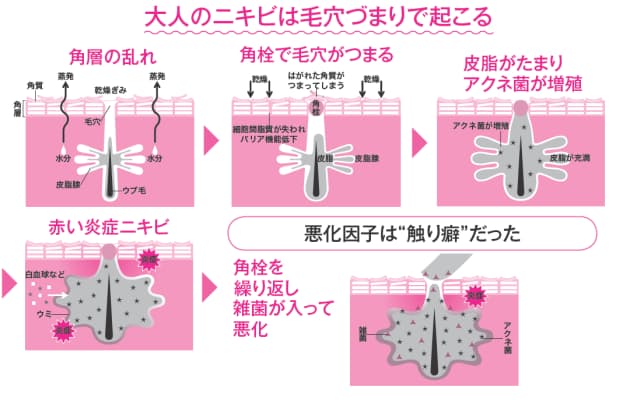 あなたの大人ニキビ 原因は 触り癖 Nikkei Style あなたの大人ニキビ 原因は 触り癖 Nikkei Style
