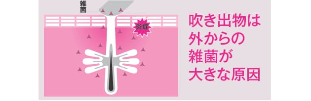 あなたの大人ニキビ 原因は 触り癖 Nikkei Style あなたの大人ニキビ 原因は 触り癖 Nikkei Style