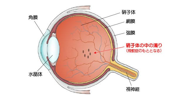 答えと解説 視界にいつも黒い点が 飛蚊症 なぜ起こる Nikkei Style 答えと解説 視界にいつも黒い点が 飛蚊症 なぜ起こる Nikkei Style