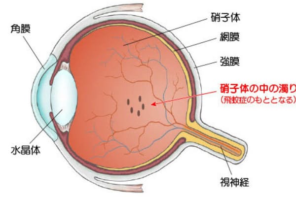 視界に浮遊物 飛蚊症 思わぬ病気や失明の恐れも Nikkei Style 視界に浮遊物 飛蚊症 思わぬ病気や失明の恐れも Nikkei Style