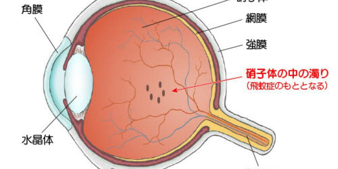 答えと解説 視界にいつも黒い点が 飛蚊症 なぜ起こる Nikkei Style 答えと解説 視界にいつも黒い点が 飛蚊症 なぜ起こる Nikkei Style