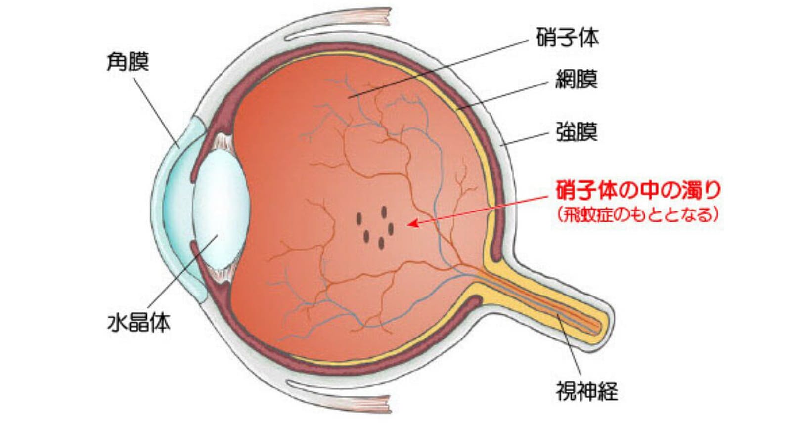 答えと解説 視界にいつも黒い点が 飛蚊症 なぜ起こる Nikkei Style 答えと解説 視界にいつも黒い点が 飛蚊症 なぜ起こる Nikkei Style