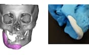 ［左］写真1　欠損部の3Dモデル
［右］写真2　骨の前駆体の粉末に硬化液を吹きつけて成型