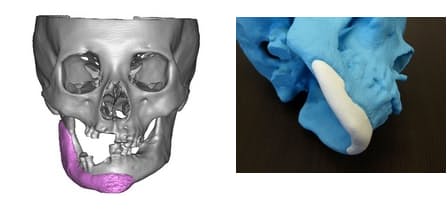医療でも3dプリンター 人工骨をカスタムメイド 日本経済新聞