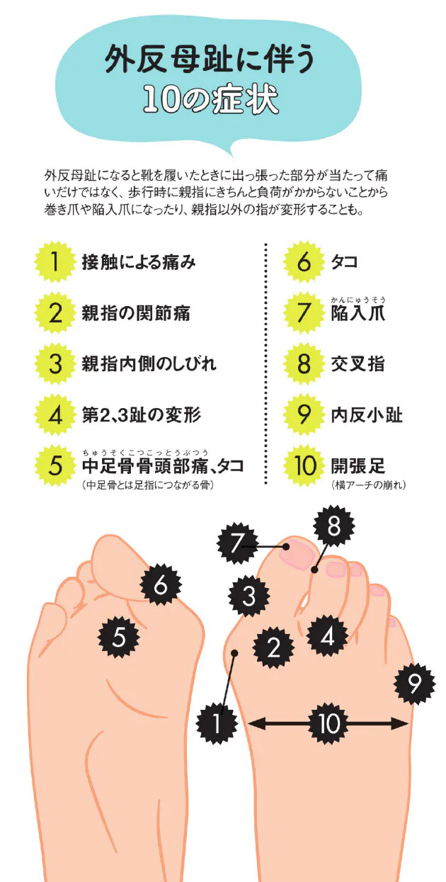 足指が硬直しないようストレッチを 外反母趾 親指だけでない症状 体のバランスに Nikkei Style 足指が硬直しないようストレッチを 外反母趾 親指だけでない症状 体のバランスに Nikkei Style