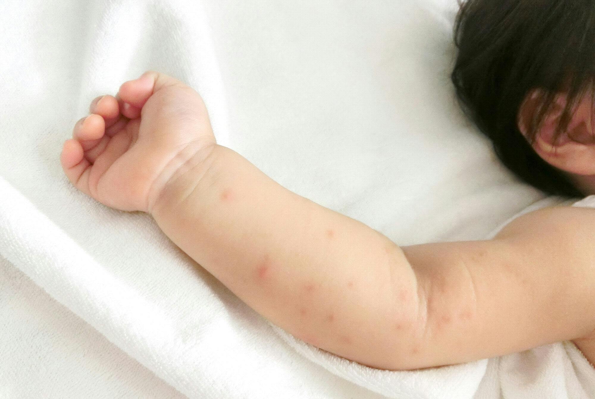 発疹が 夏に流行の手足口病 大人も感染 重症化注意 Nikkei Style 発疹が 夏に流行の手足口病 大人も感染 重症化注意 Nikkei Style