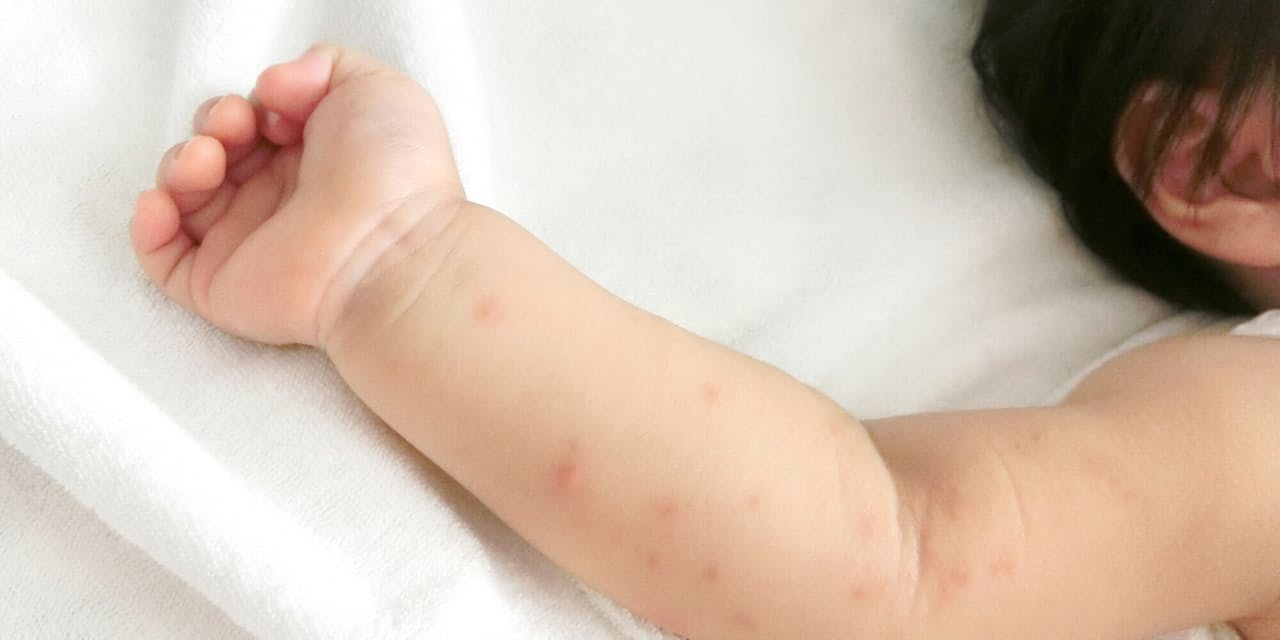 発疹が 夏に流行の手足口病 大人も感染 重症化注意 Nikkei Style 発疹が 夏に流行の手足口病 大人も感染 重症化注意 Nikkei Style