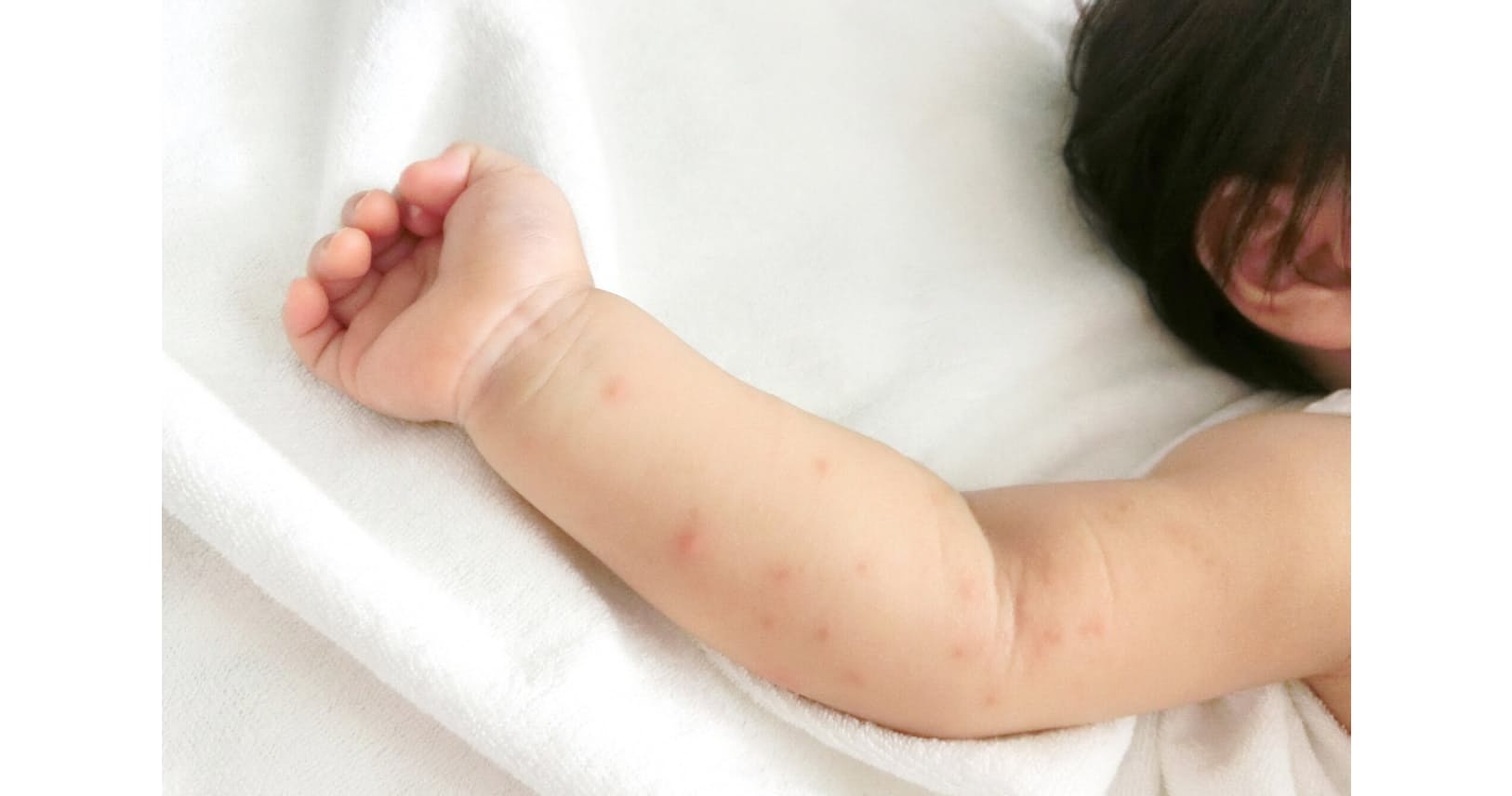 発疹が 夏に流行の手足口病 大人も感染 重症化注意 Nikkei Style 発疹が 夏に流行の手足口病 大人も感染 重症化注意 Nikkei Style