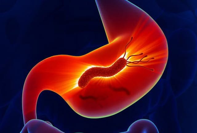 胃に棲みつくピロリ菌は胃の粘膜を萎縮させ、胃がんを引き起こします。（写真＝123RF）