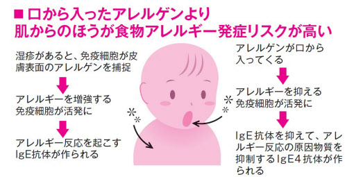 食物アレルギーは肌の湿疹から始まる 乳児期から保湿を 日本経済新聞