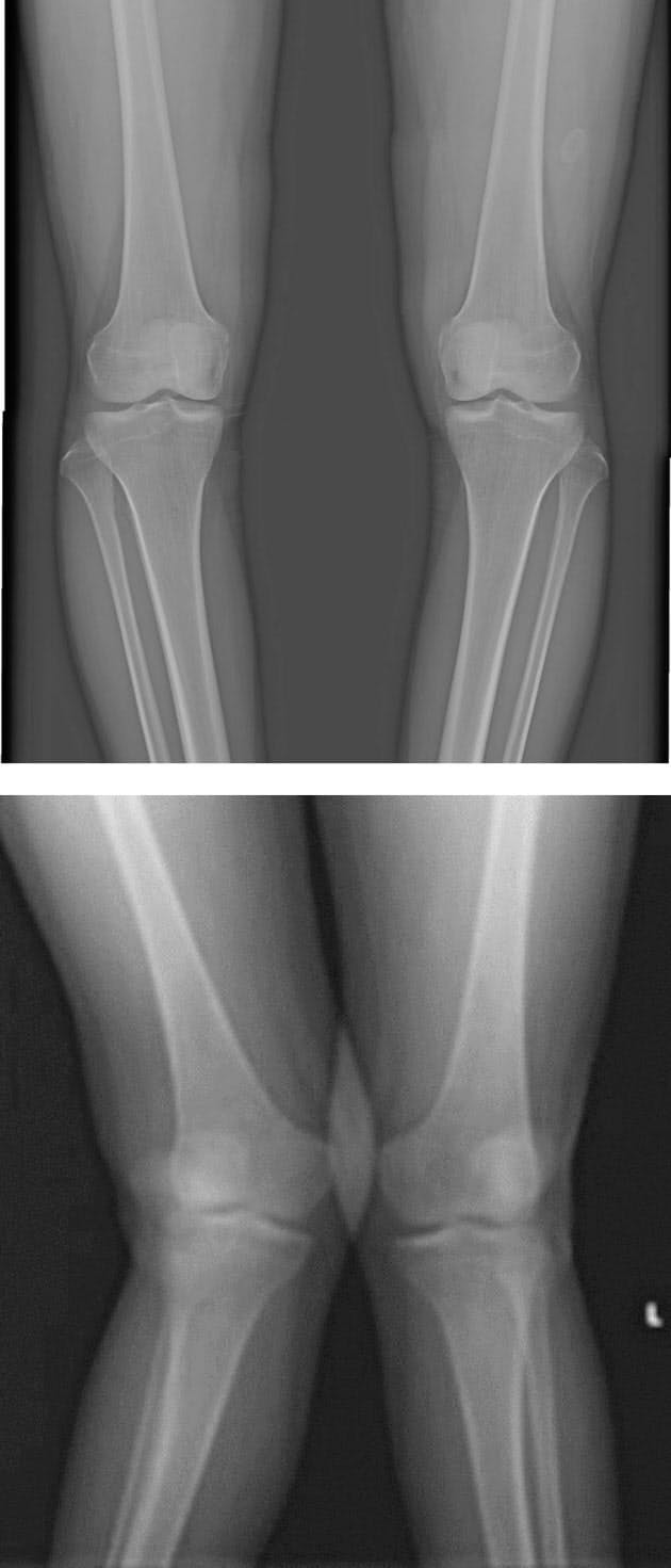 大人のo脚 膝痛注意 変形性膝関節症かも Nikkei Style 大人のo脚 膝痛注意 変形性膝関節症かも Nikkei Style