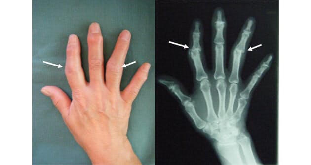 指の変形 原因はホルモンバランス Nikkei Style 指の変形 原因はホルモンバランス Nikkei Style