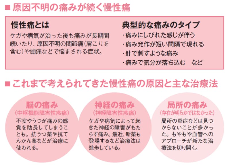 原因不明のしつこい痛み 犯人は もやもや血管 かも Nikkei Style 原因不明のしつこい痛み 犯人は もやもや血管 かも Nikkei Style