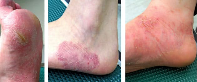 足のかゆみ 水虫か 正確な判定は顕微鏡で Nikkei Style 足のかゆみ 水虫か 正確な判定は顕微鏡で Nikkei Style