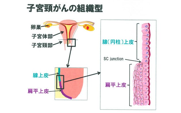 20代 30代の働く女性にも急増 子宮がんのリスク Nikkei Style