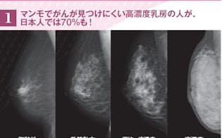 マンモで撮影した乳房の画像。放射線科医が診断（読影）する際、上のように4段階に分ける。左の2つは欧米人に多い脂肪性の乳房で、マンモで乳がんが見つけやすい。一方、右の2つは日本人の70%に見られるという高濃度乳房（デンスブレスト）で乳がんが見つけにくい（画像提供:NPO法人乳がん画像診断ネットワーク　http://bcin.jp/）