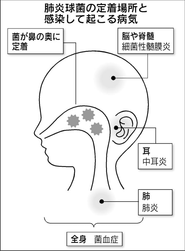 子どもの細菌性髄膜炎 ワクチンで備え 欧米での実績豊富 課題は経済的負担 Nikkei Style 子どもの細菌性髄膜炎 ワクチンで備え 欧米での実績豊富 課題は経済的負担 Nikkei Style
